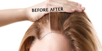 caduta dei capelli menopausa