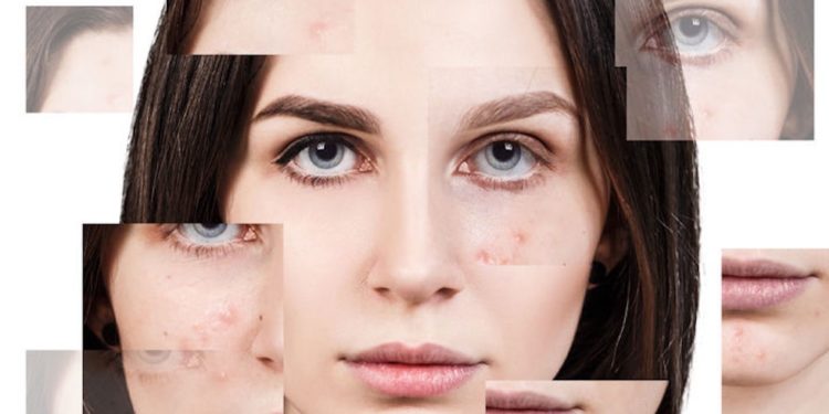 Acne-in-menopausa-e-perimemopausa